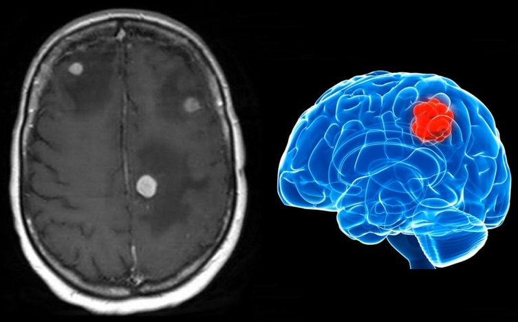 【视频】脑转移瘤治疗概述，脑转移应该选哪种方案进行治疗？